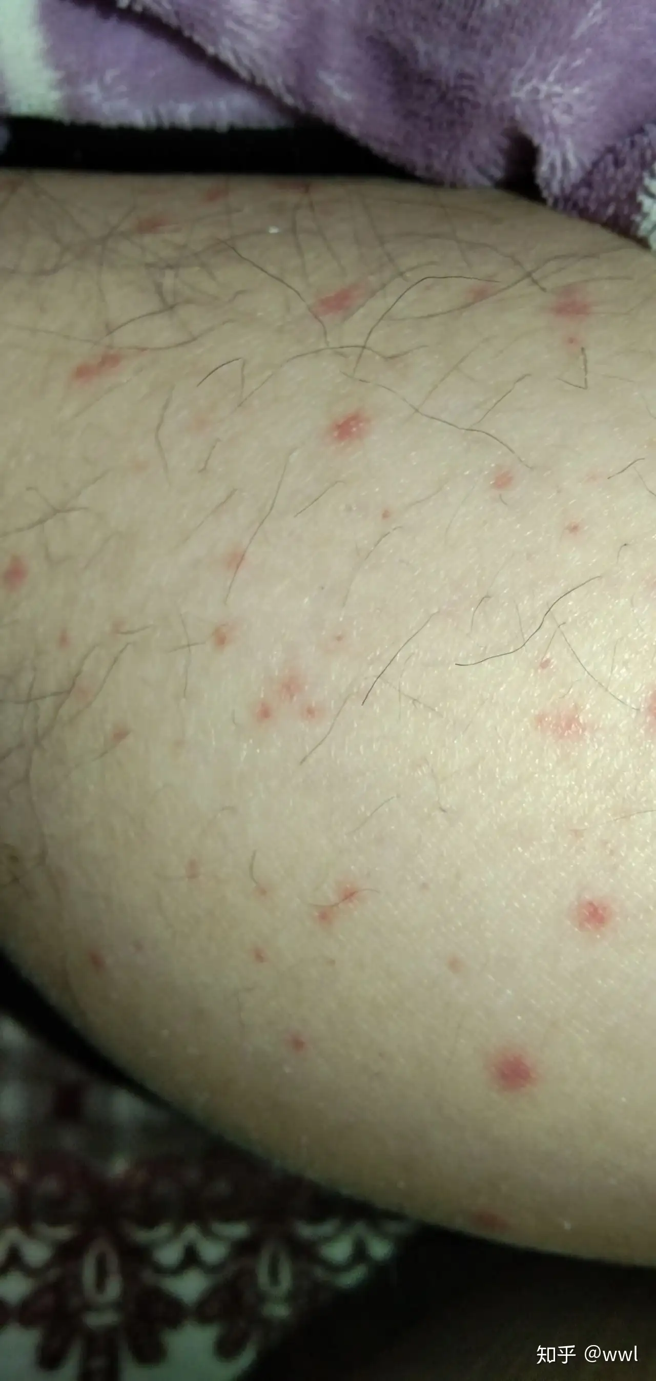 腿上长红点，不痛不痒这是什么？ - 知乎