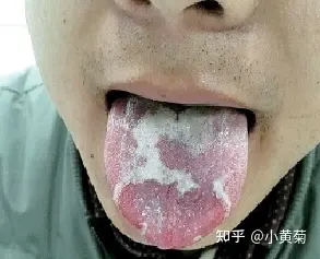 舌头舌苔脱落图片