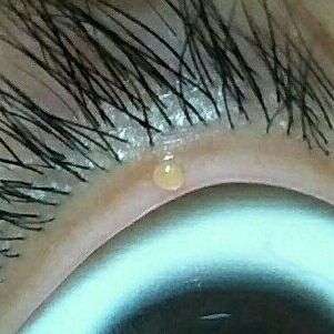 眼睛睫毛根部长疙瘩不痛不痒用手可以扣掉类似痘痘的这是什么