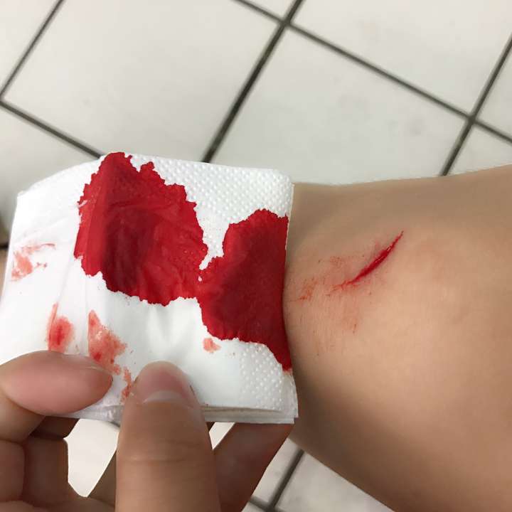 你身上的疤痕有着怎样的故事?