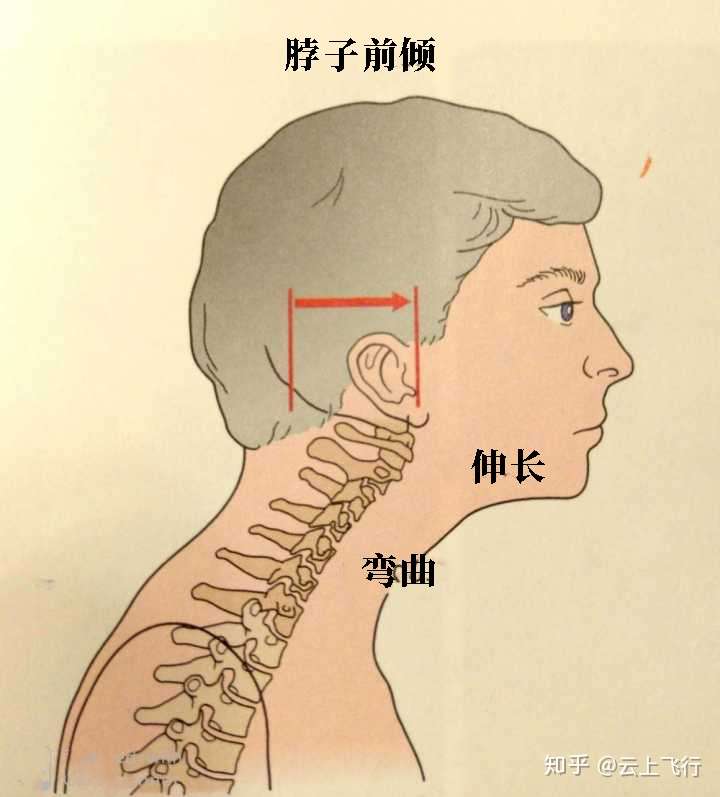 引体能改善脖子前倾吗?