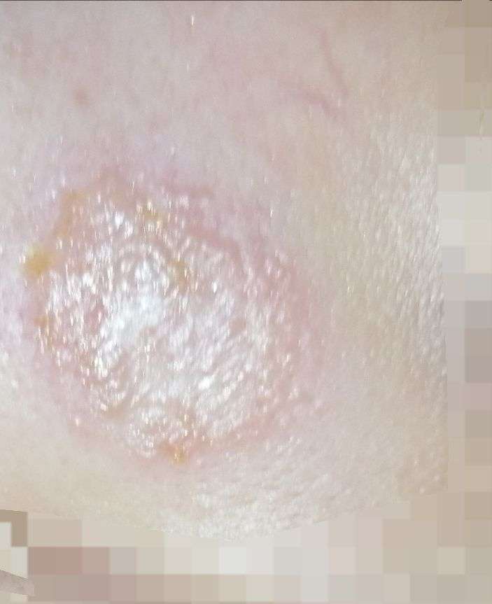 脸上长了一片红红痒痒的痘痘,后来留黄水还结了小小的黄黄色的痂,要