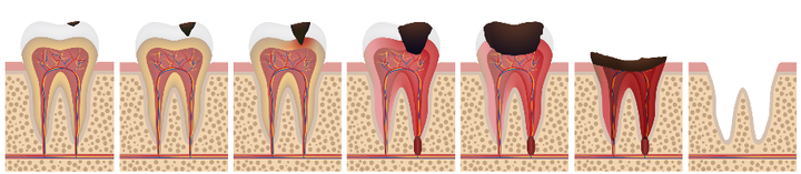 蛀牙会导致牙齿丧失，你的蛀牙处于哪个阶段？