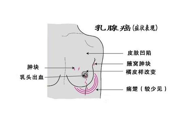 乳腺瘤的早期症状图片图片