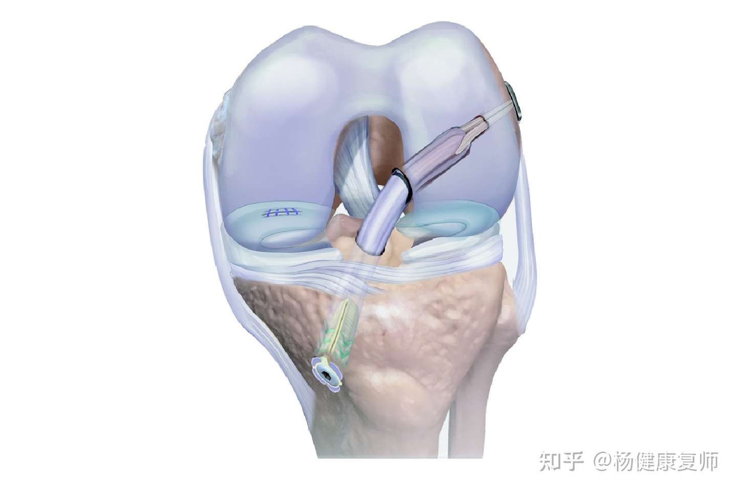 前交叉韧带重建术后关节粘连的原因与处理方法 一 知乎