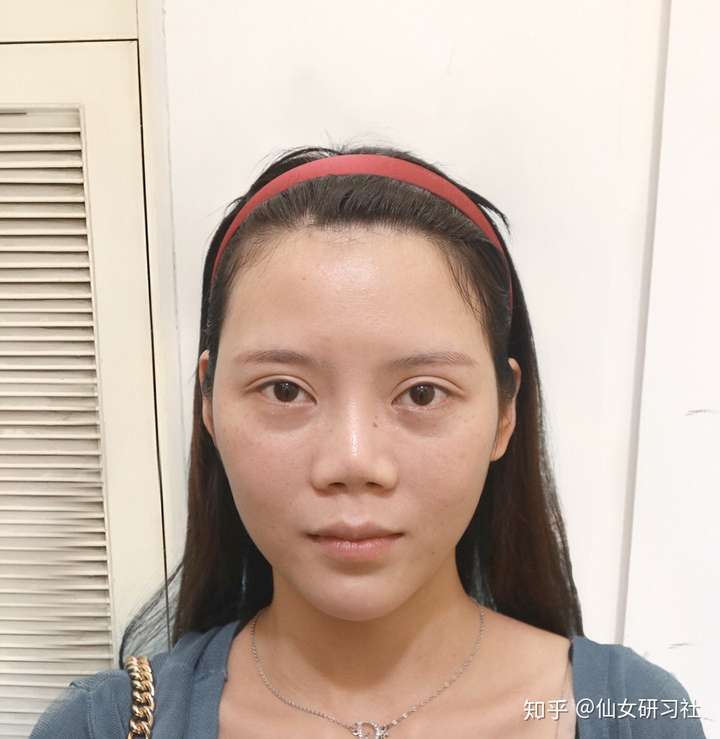 这位小姐姐也是鼻修复,术前出现了严重的挛缩,出现了所谓的"猪鼻子"