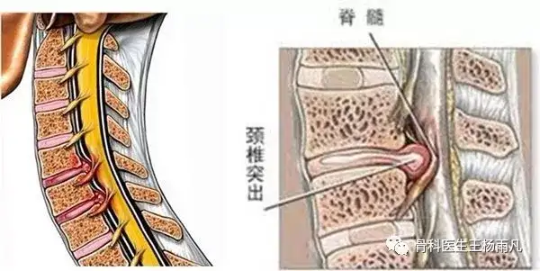 你好 颈椎病 系列科普 一 哪些症状说明你得了颈椎病 知乎