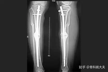 腓骨骨折怎么手术处理 骨折术后注意这七点 骨骼愈合更轻松 知乎