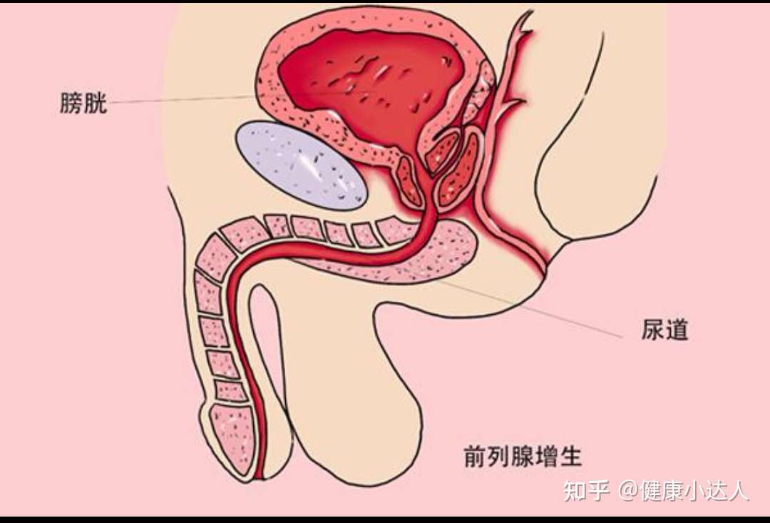 健康小达人 的想法: 前列腺怎么治疗效果好 前列腺炎患者占泌
