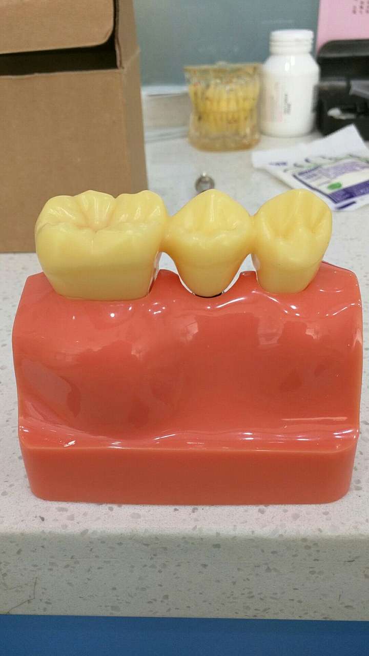 烤瓷桥掉了以后,是继续做烤瓷牙桥,还是种植牙加烤瓷牙冠?