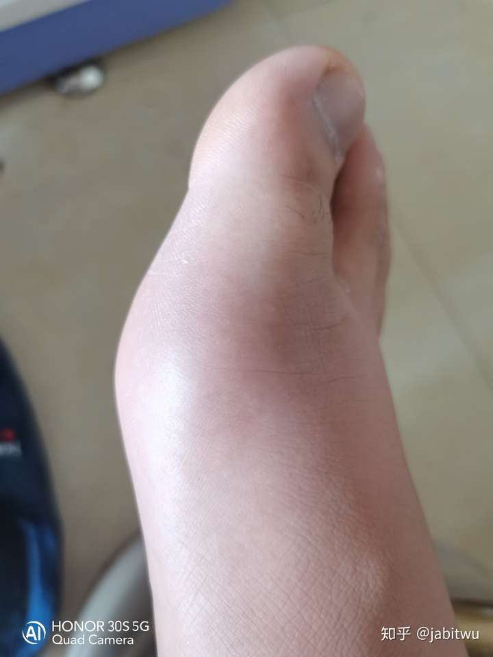 第一次痛风 - 知乎