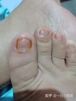 治疗灰指甲只需牢记这三点,轻松治好灰指甲,不再复发! - 知乎