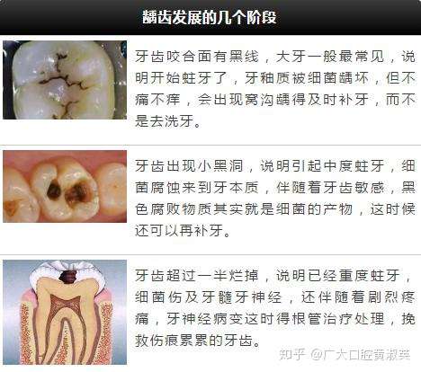 牙齿龋坏到什么程度需要做根管治疗