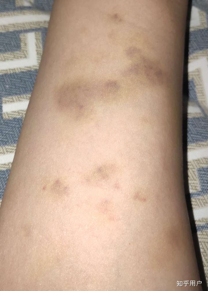 有一个喜欢掐人且下手比较重的女朋友是一种怎样的体验?