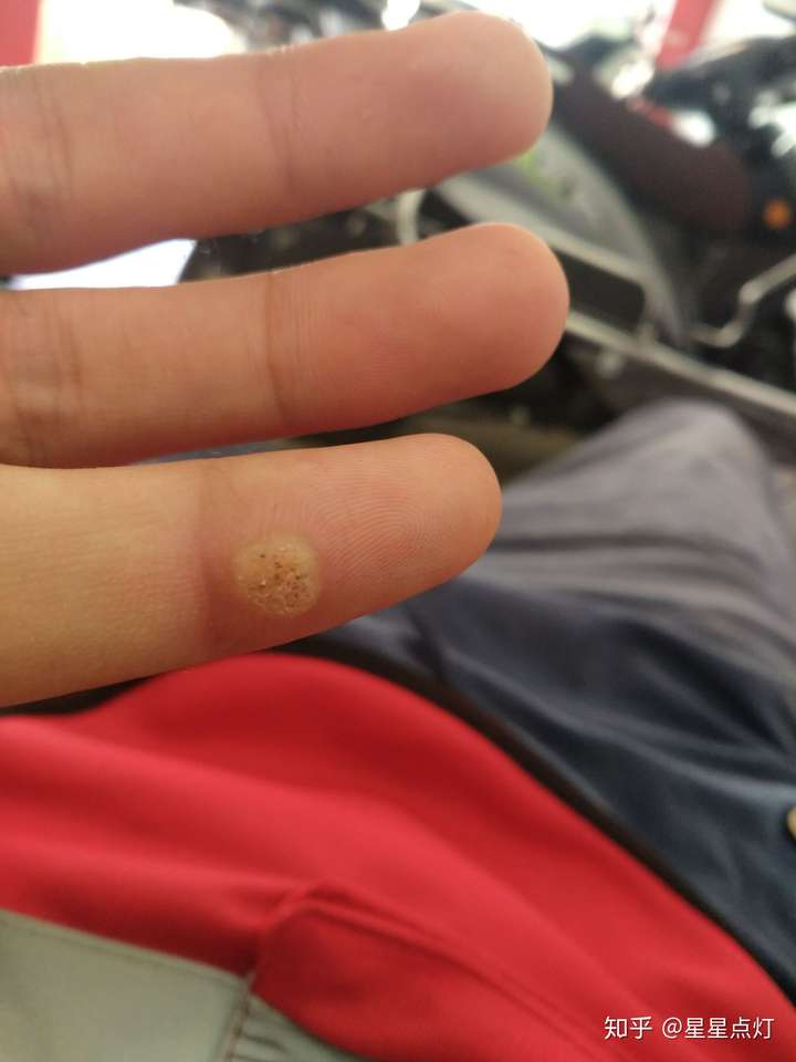 小拇指长了一个类似茧子的肉?