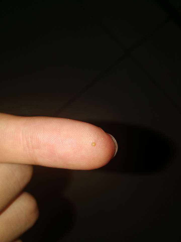 请问你们耳朵壁会长黑头吗?一颗一颗的黑的?