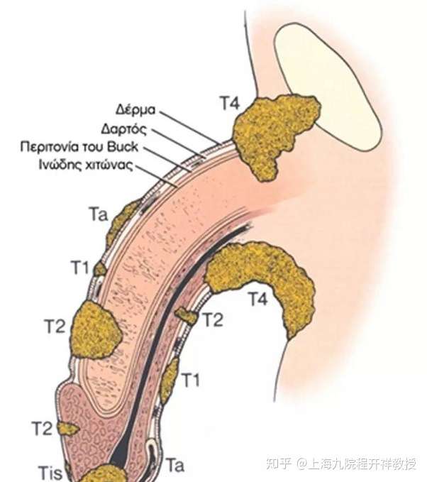 带您认识阴茎癌 知乎