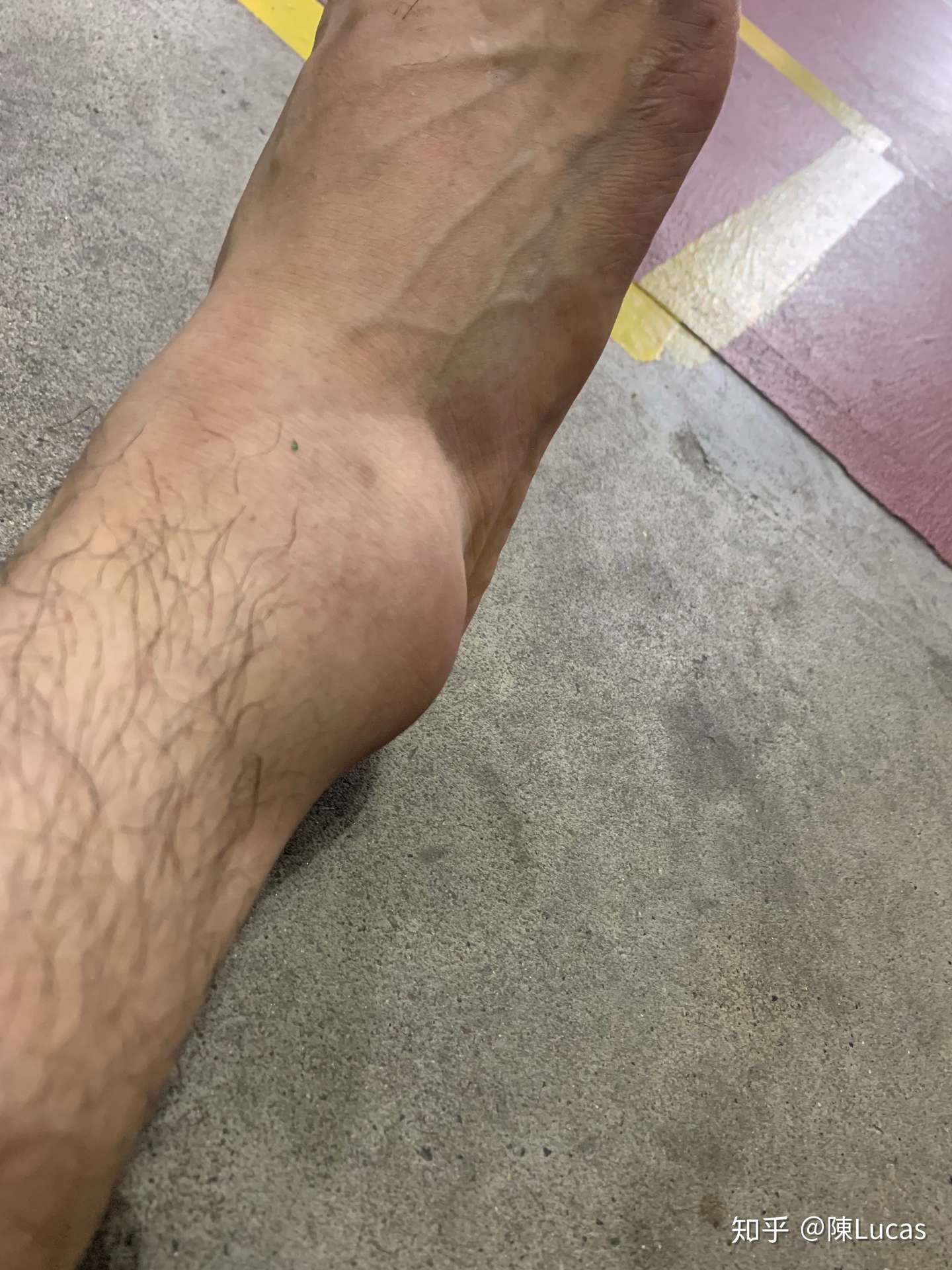 记录韧带断裂 知乎