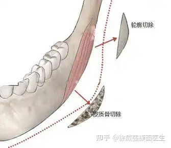 什么是劈外板劈外板有伤害吗