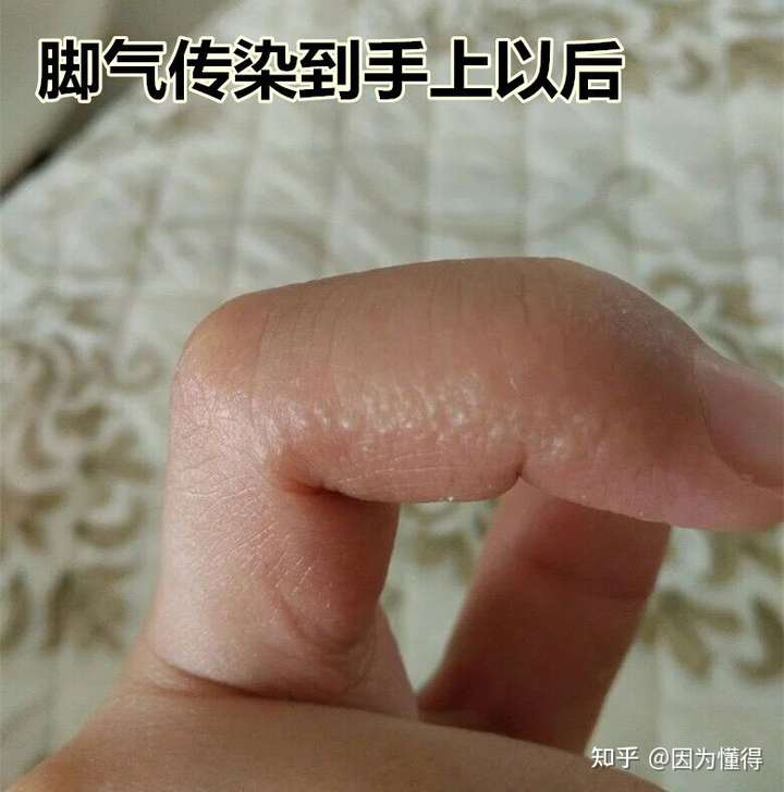 脚气会传染到手上吗?