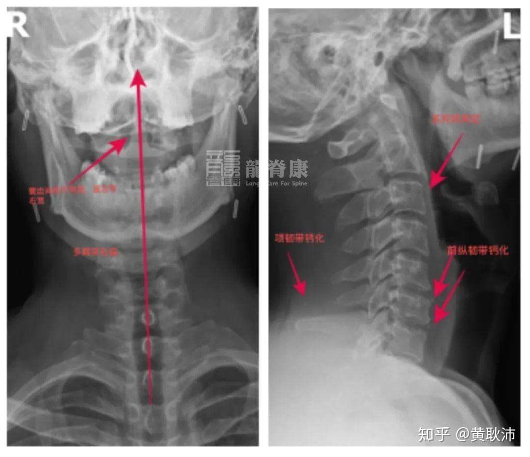 颈椎间盘突出需要手术吗 什么情况下建议手术 知乎