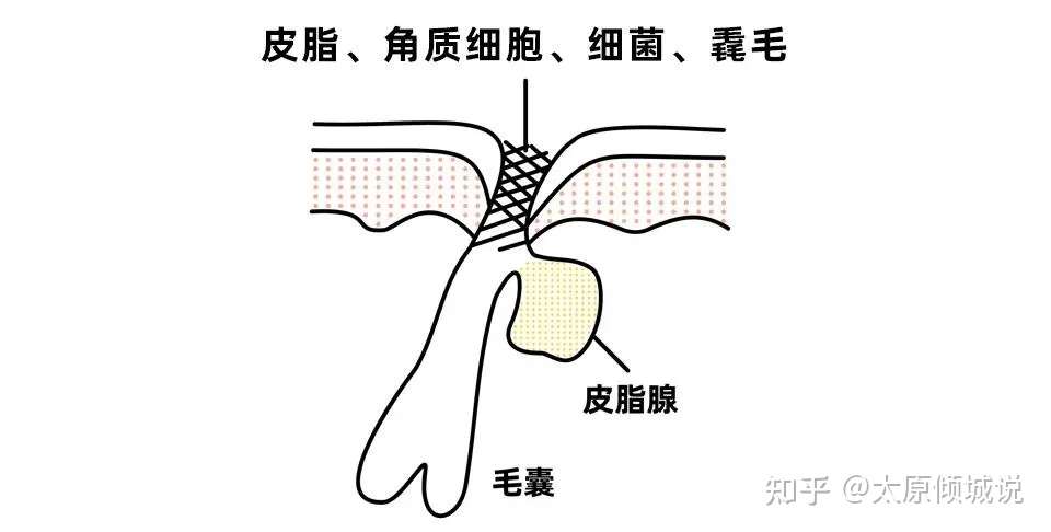 倾城小课堂 去黑头的方法 只推荐这几种 知乎