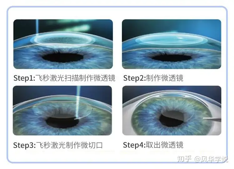 史上最全的近视手术科普，一文解决99%的疑问（论文级详细） - 知乎