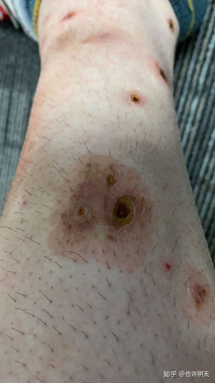 变应性皮肤血管炎怎么治疗,危害大不大