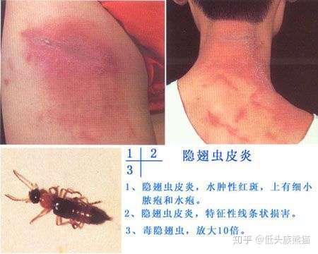 似乎是尾巴带夹子的黑色细长虫子不到一厘米的夹了一下子肿了很疼这个