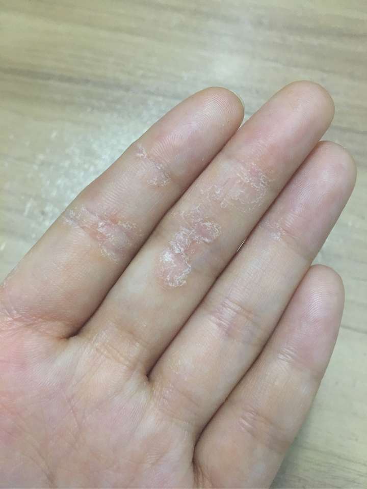 某小块区域变硬,角化脱屑,但不痒.