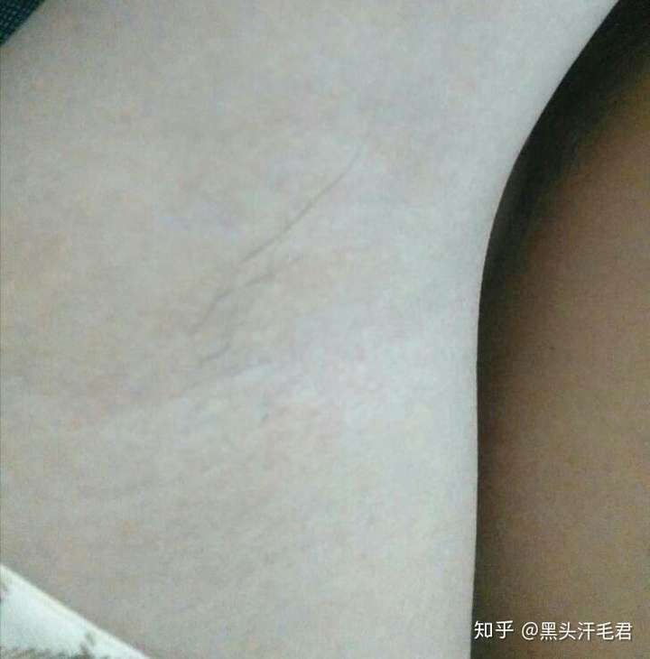 腋下汗毛图片