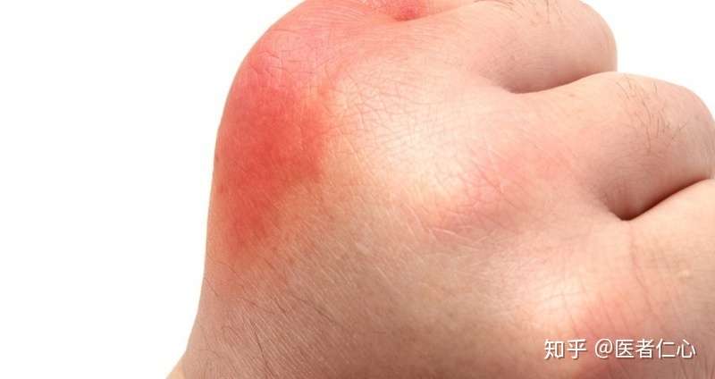 血友病与白血病是一回事吗 知乎