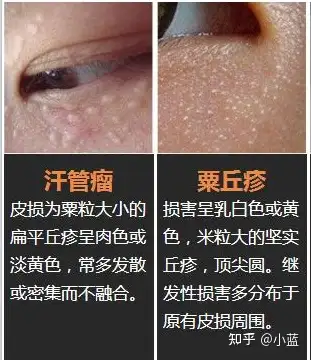 阴囊皮肤汗腺腺瘤图片