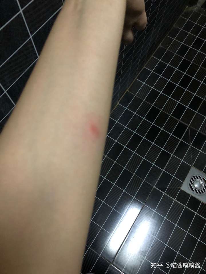 这是个什么虫子像个飞蚂蚁纯黑叮一下一波一波的灼烧痛感如潮