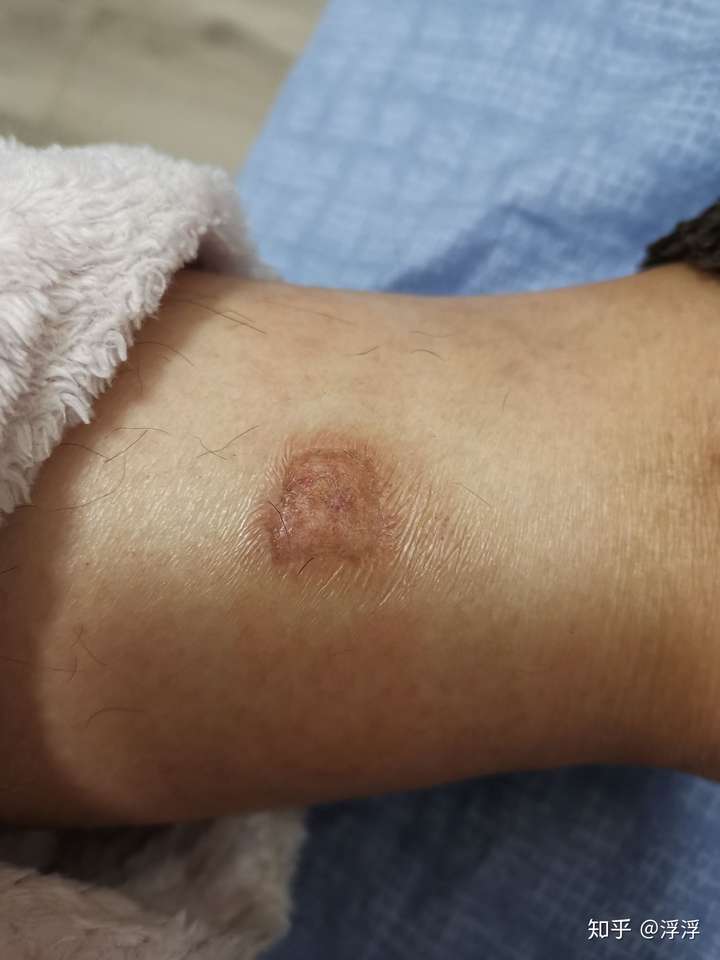 艾灸烫伤没有戳破,多长时间能恢复?