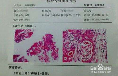 「鳞状细胞癌」的病理是什么,医学上是如何诊断与治疗的?