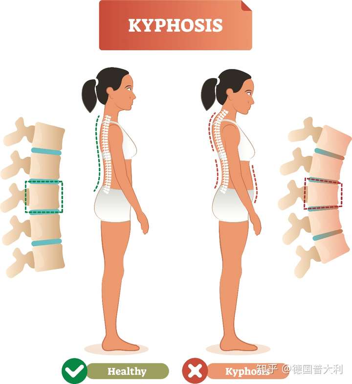弓背和驼背的区别图图片