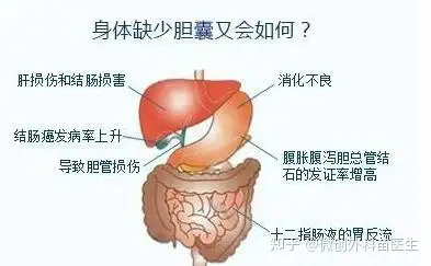 保胆取石还是胆囊切除?看济南106医院专家怎么说 - 知乎
