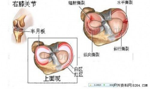 健康问答 半月板损伤属于不可逆损伤吗 知乎