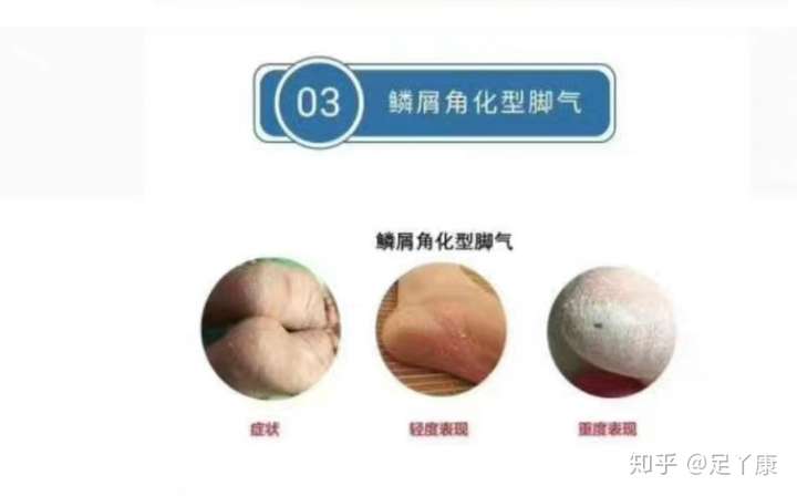 足丫康 专业治疗皮肤疾病 67我们这期讲一下脚气的类型及如何快速