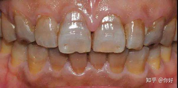 你好 如氟斑牙,四环素牙,断裂残缺牙,瓜子牙,黄牙,烟牙,茶渍牙等