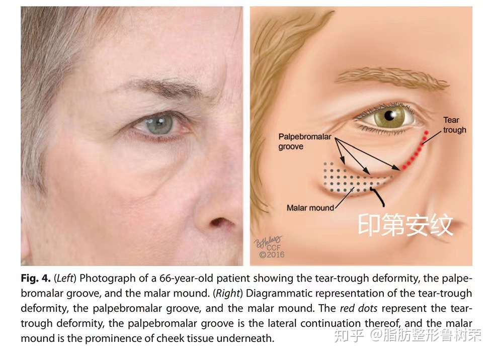脂肪整形鲁树荣 的想法: 看看什么是泪沟,睑颊沟,颧袋和印第安纹