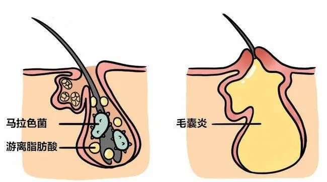 洗發(fā)水推薦排行榜 | 超全深度測評熱門洗發(fā)水：除菌祛痘、去屑止癢、控油蓬松、防脫養(yǎng)發(fā)？最強王者毫無懸洗發(fā)