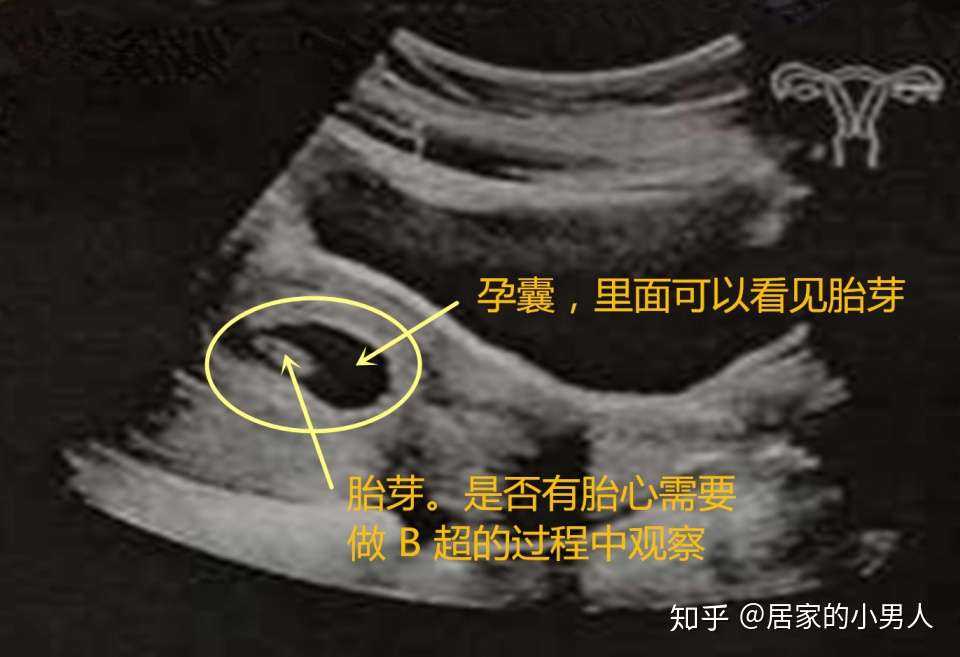 关于孕囊 胎芽 胎心 这些知识你需要了解 知乎