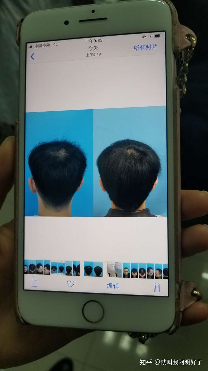 在某宝上买的海维斯育发液有用吗