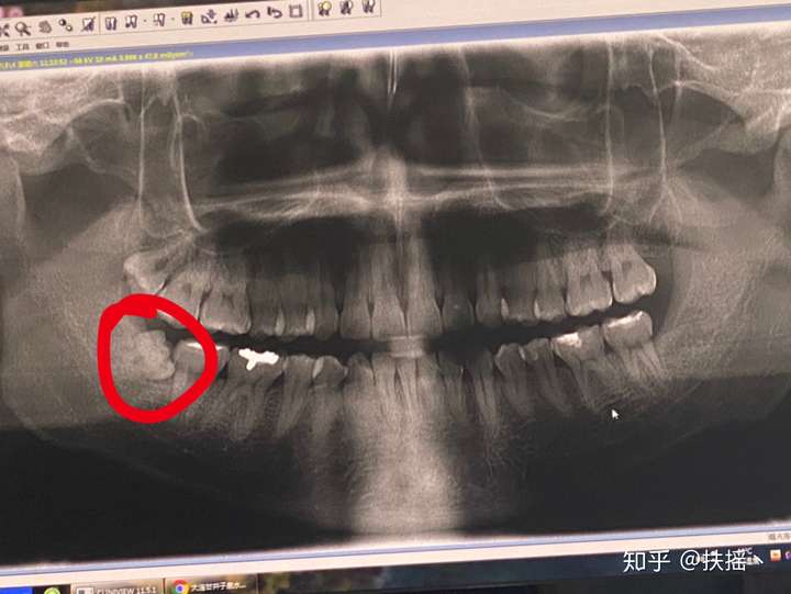 拔完智齒兩週不是幹槽症終於不疼了