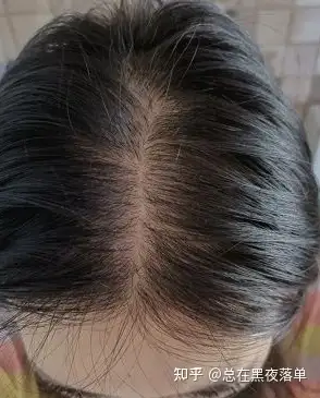 吃黑芝麻丸究竟有什么好处真的能让头发变黑变浓密吗