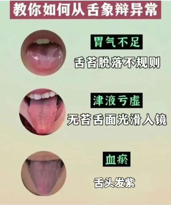 中医朱瞻基 的想法: 中医教你如何舌象辩异常! | 舌为心之苗,… - 知乎