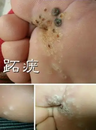 轻松治疗跖疣顽固性皮肤病的无痛治疗
