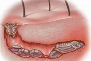 做过包皮手术后有两个月,水肿还没有消.怎样可以恢复快一点呢?